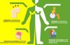 Hemiplegia